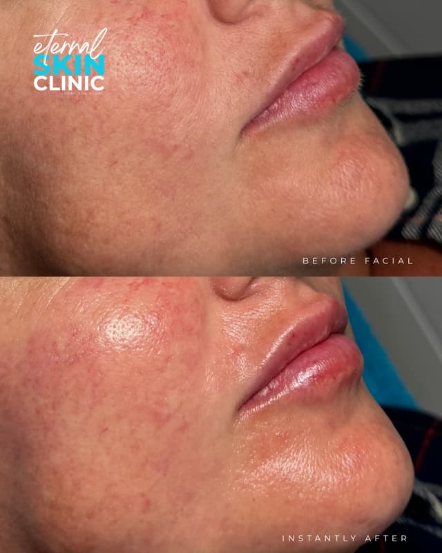 Ultimate Glass Skin Facial