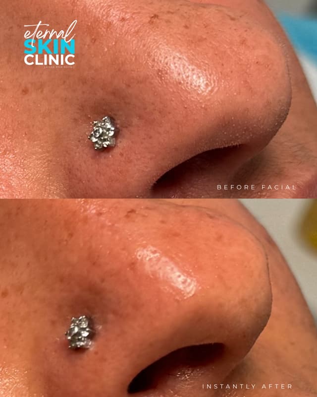 Manual Nose Extractions