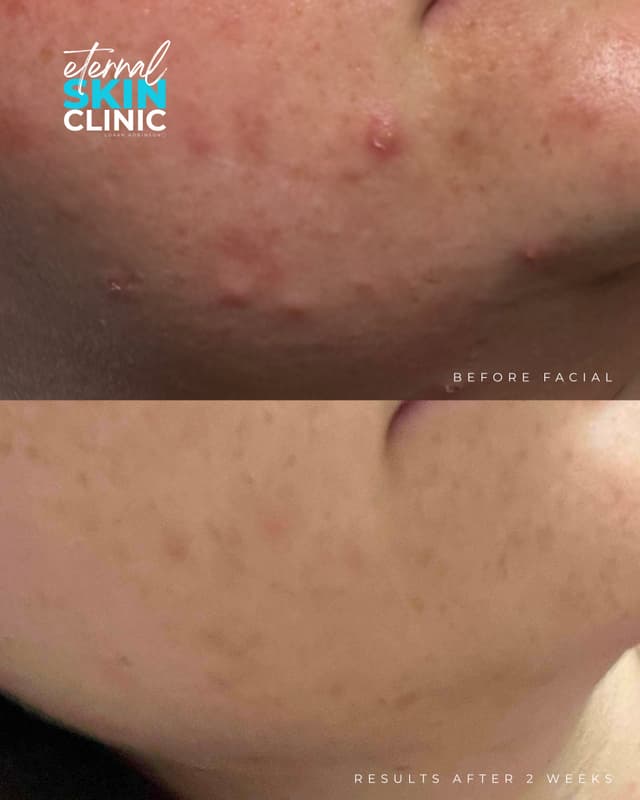 Chemical Peel Facial