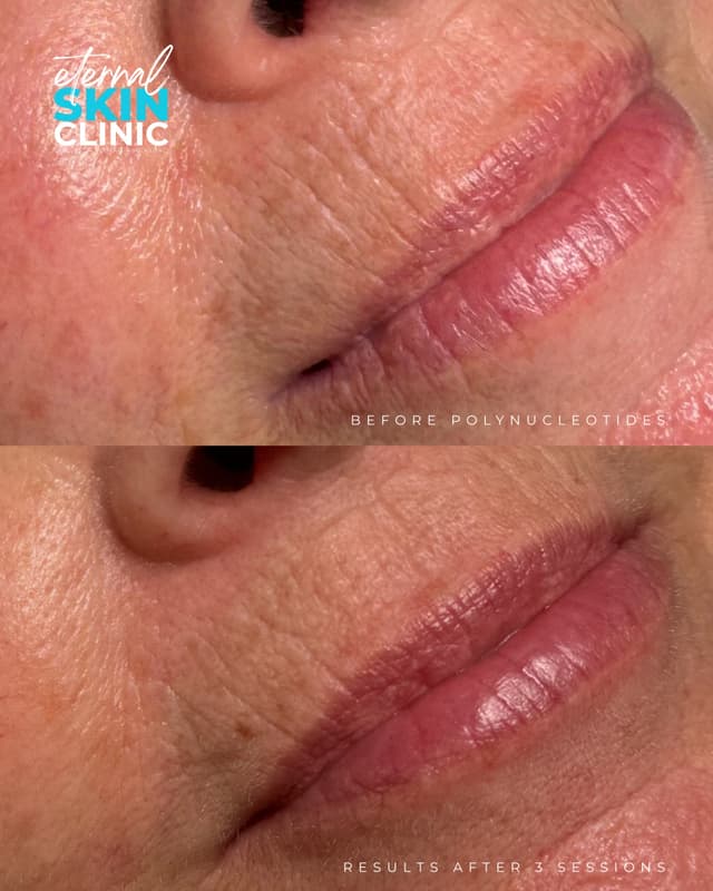 Plenhyage Polynucleotides