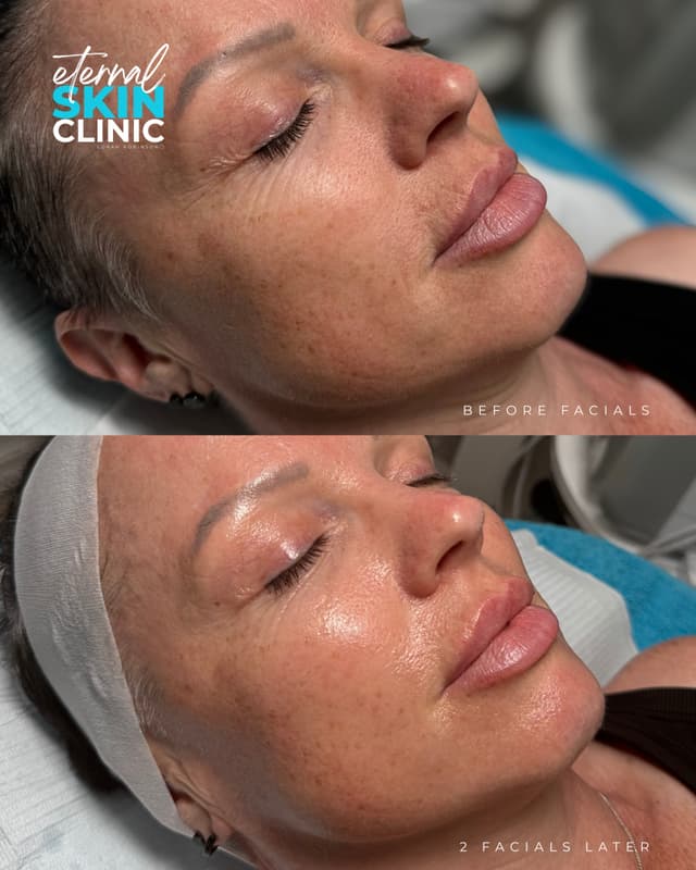 Ultimate Exosomes Facial