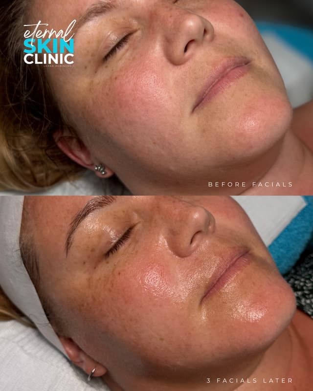 Microneedling Facial
