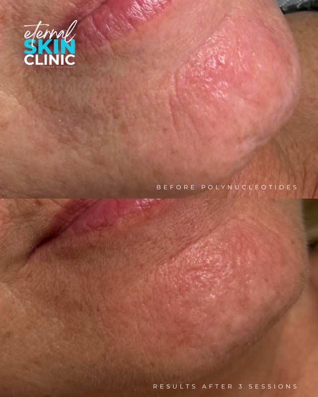 Plenhyage Polynucleotides