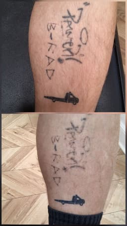 Progress after one Laser tattoo removal session