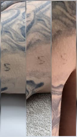 Tiny tattoo removal progress after 2 sessions