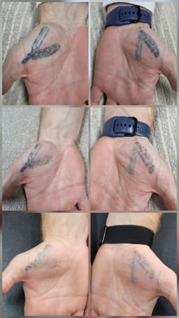 Progress with laser tattoo removal
