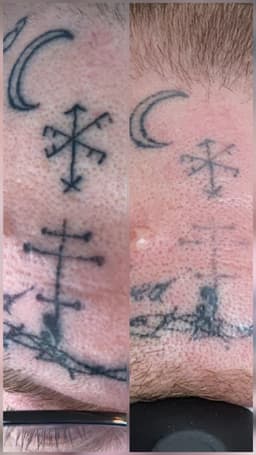 Facial tattoos starting to eliminate