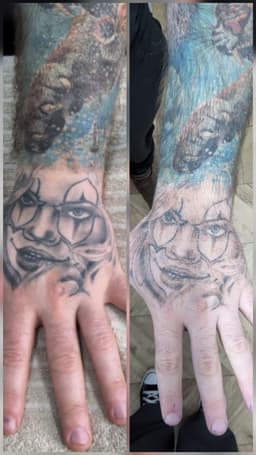 Great fade after one session of tattoo removal