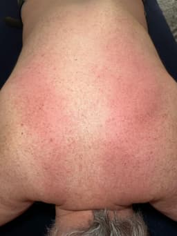 Myofascial Release on back