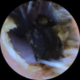 Very old ear wax  client unaware until camera inserted