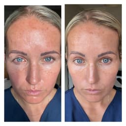 Skin peel Glow, strength 2. ✨