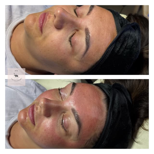 Dermaplane and microneedling facial