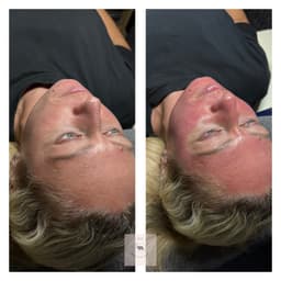 Microneedling + painless peel and LED
