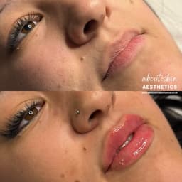 Lip filler