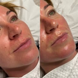 Microneedling