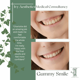 Gummy Smile