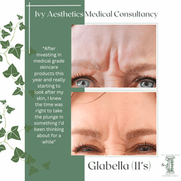 Glabella