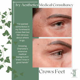 Crows Feet