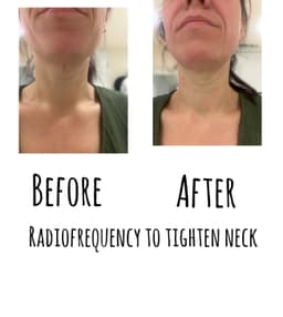 Radiofrequency neck tightening 1 session
