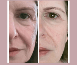 Results after 1 HIFU 8weeks post treatment