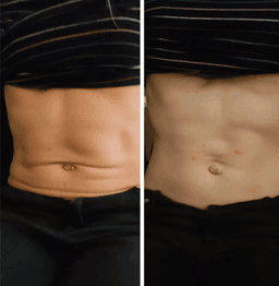 Emsculpt results after 1 30min treatment