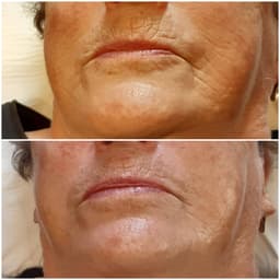 Results after 1 delux treatment