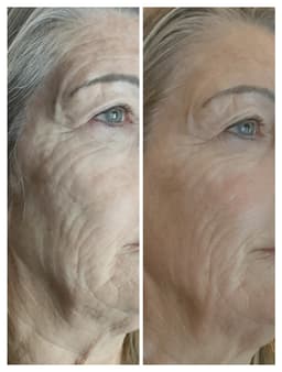 Results after a course of CACI