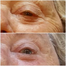 Results after 1 delux CACI treatment