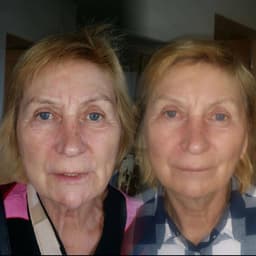 Results 8 weeks post HIFU treatment