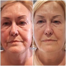 Results after a course of CACI
