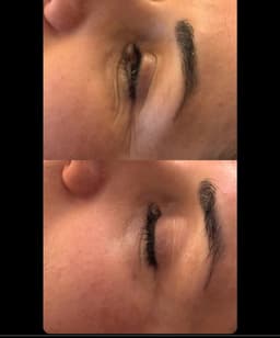 MDF microneedling results