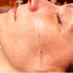 Dermaplaning