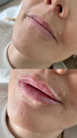 1ml Lip Filler