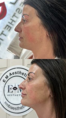3ml Facial Contouring