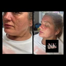 Cheeks jawline and pre jowl