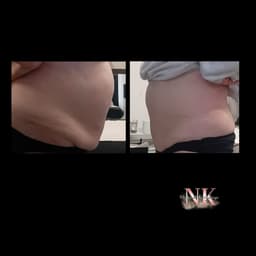 2 sessions of lemon bottle fart dissolving injections