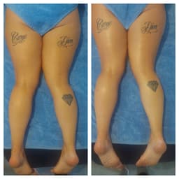 Brazilian lymphatic drainage massage