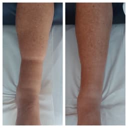 Manual lymphatic drainage