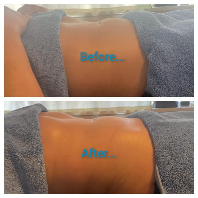 Brazilian lymphatic drainage