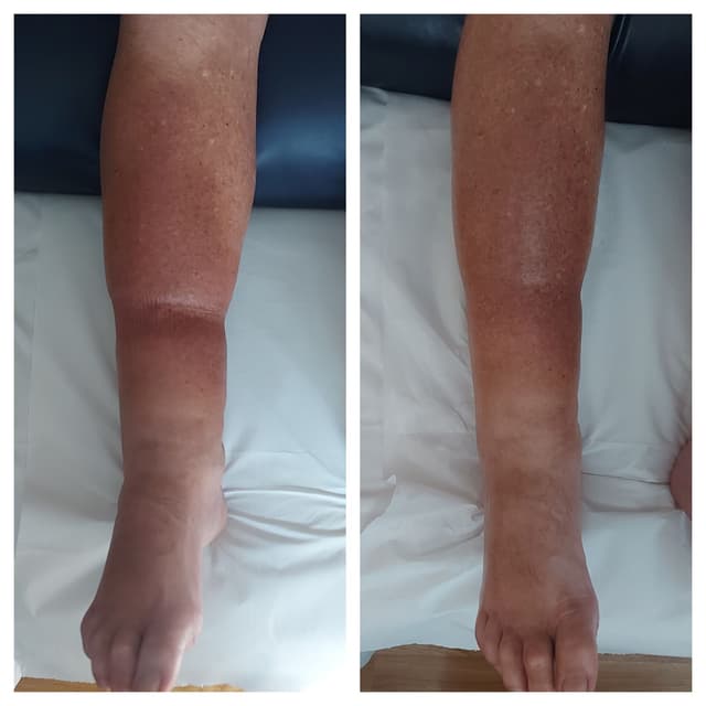 Manual lymphatic drainage