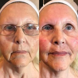 Anti Wrinkle Treatments in Windsor