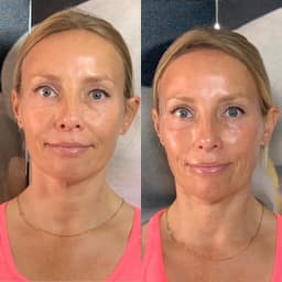 Obagi Blue Peel Radiance Facial in Windsor