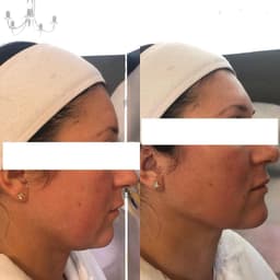 Dermal Filler Treatment in Windsor