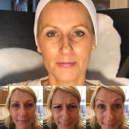 Skin Tightening Treatments in Windsor