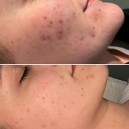 Before and after Greenpeel course