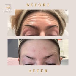 Before & After | Botox