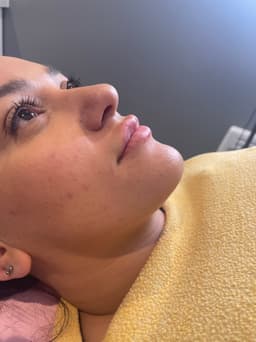 Natural Lip Augmentation