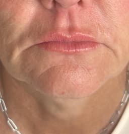 Natural Lip Augmentation