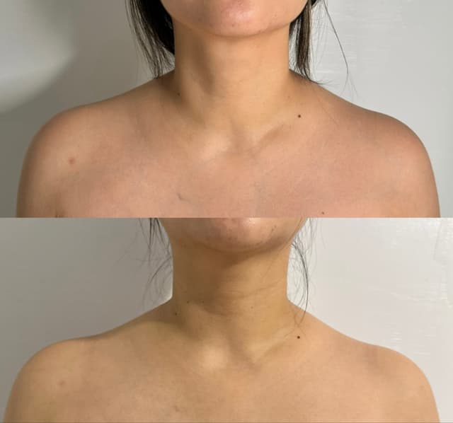 TrapTox targets the trapezius muscles to slim the shoulders, elongate the neck, and relieve tension. Ideal for those wanting a more refined silhouette or relief from shoulder tightness. Results appear in 7–14 days and last 3–4 months.