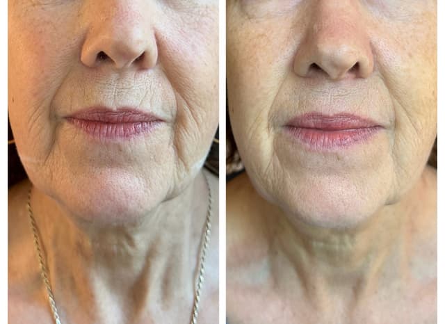 HIFU (High-Intensity Focused Ultrasound) is a non-surgical treatment that targets the under-chin area to lift sagging skin, reduce a double chin, and define the jawline. It stimulates collagen deep beneath the skin for a firmer, more sculpted look with no downtime. Perfect for those seeking a natural lift without fillers or surgery.